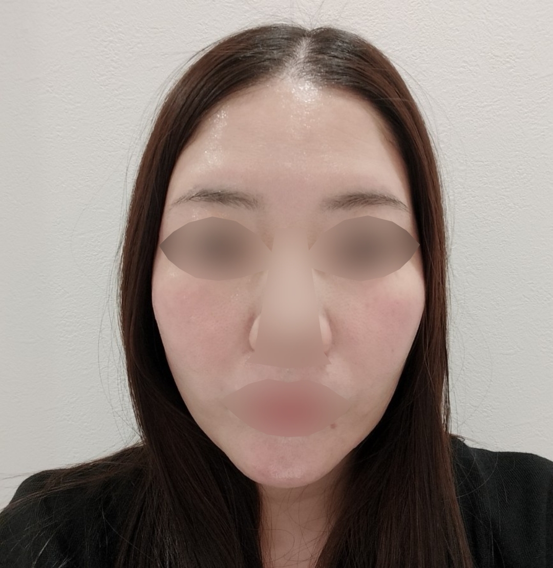 何度でも可】美顔レーザートーニング｜シミ・肝斑・毛穴・くすみ改善
