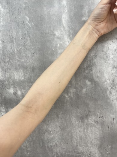 after photo: 白玉注射・点滴, ビタミン注射・点滴