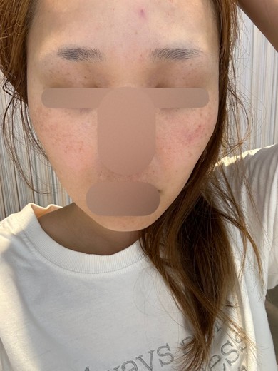 after photo: スキンボトックス