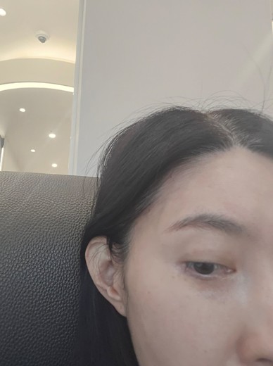 after photo: 귀필러