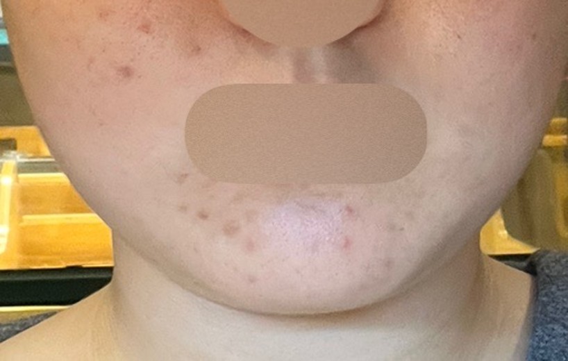 after photo: 여드름압출