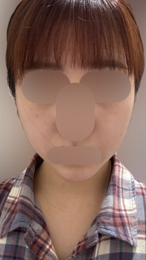 before photo: チタニウムリフト