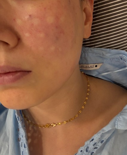 after photo: 스킨보톡스