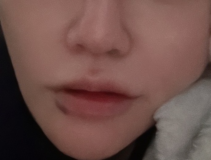 after photo: 唇ヒアルロン酸