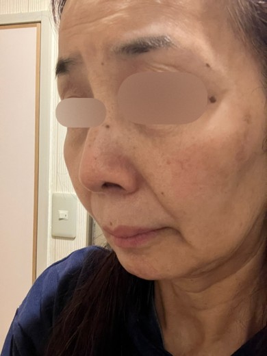 before photo: エレクトロポレーション