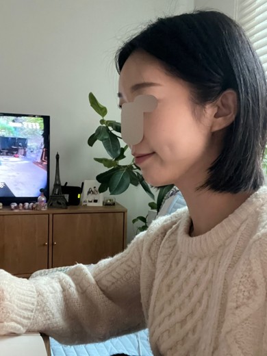 after photo: 턱끝필러