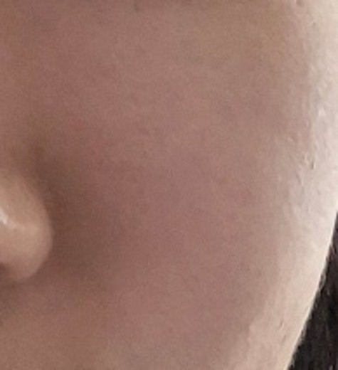 after photo: PRP피부재생술