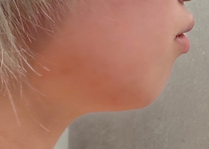 after photo: 脂肪溶解注射(顔)