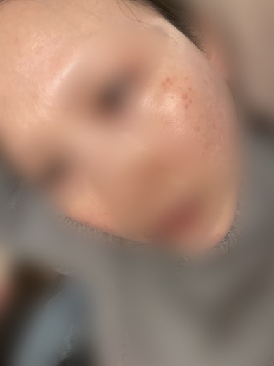before photo: IPL(光/フォト治療)
