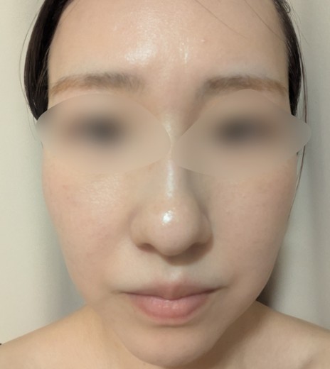 after photo: IPL(光/フォト治療), ピーリング