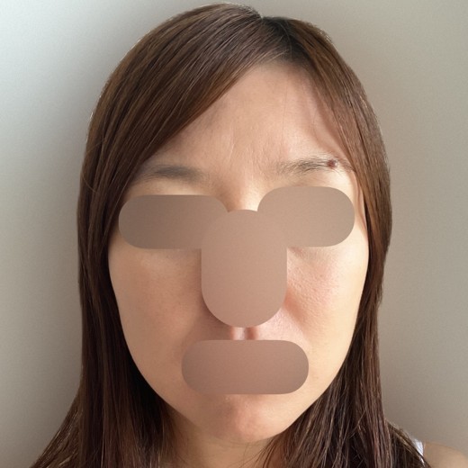 before photo: IPL(光/フォト治療)