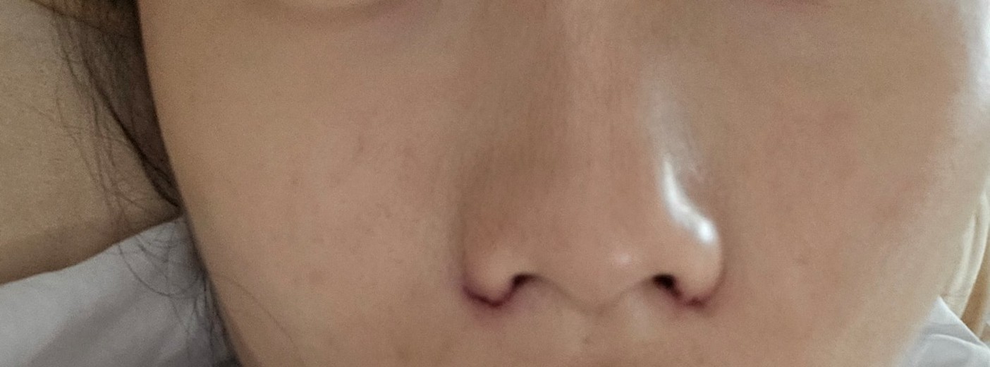 after photo: 콧볼축소