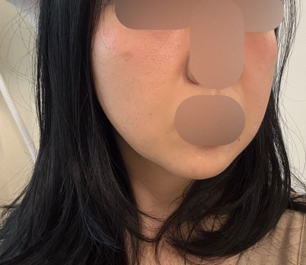 after photo: PRP피부재생술