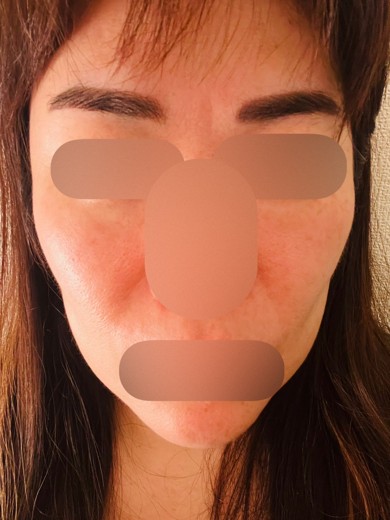 after photo: ヴェルベットスキン