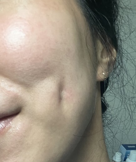 after photo: 보조개성형