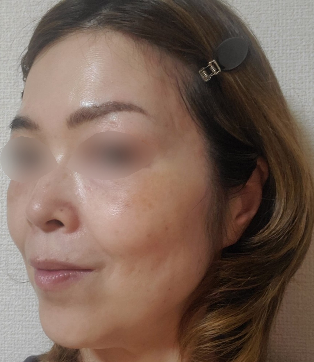 エレクトロポレーション【再来OK】 | ライズワン美容皮膚科クリニック