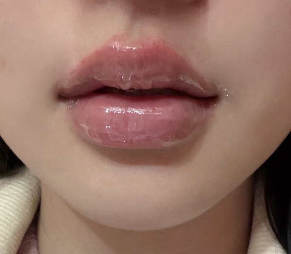 after photo: 입술필러