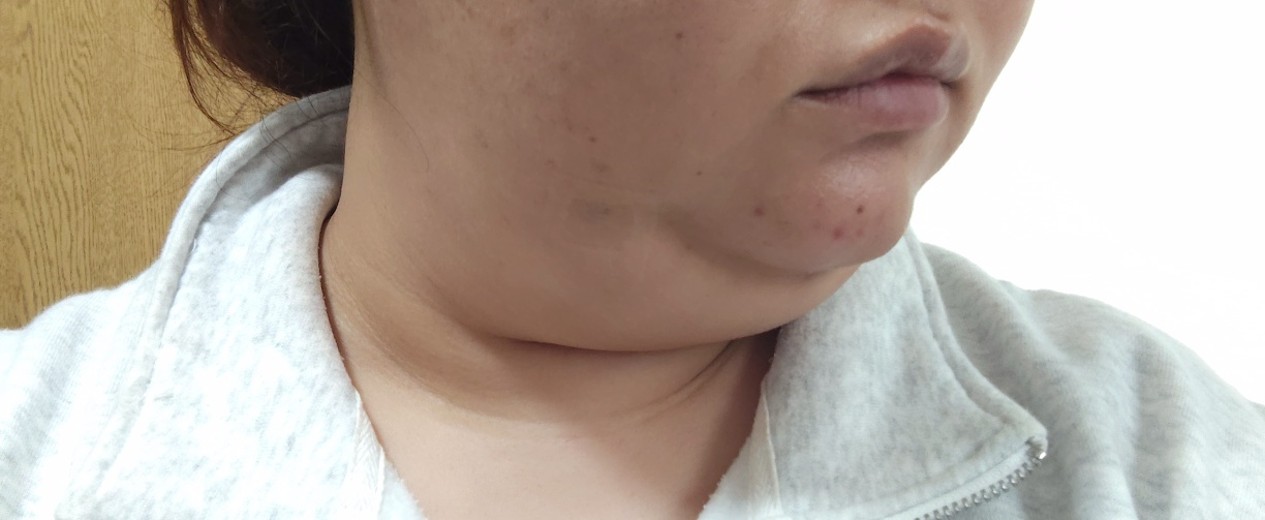 after photo: 脂肪溶解注射(顔)
