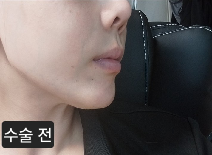 before photo: 턱끝보형물제거