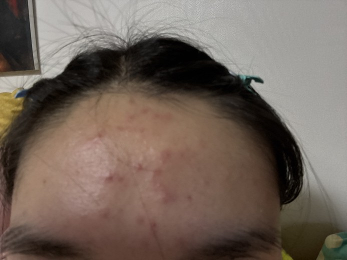 after photo: 스킨스케일링, 여드름압출