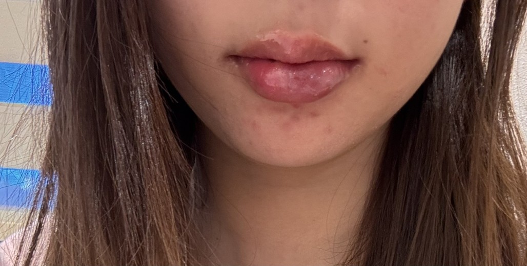 after photo: 입꼬리필러, 입술필러