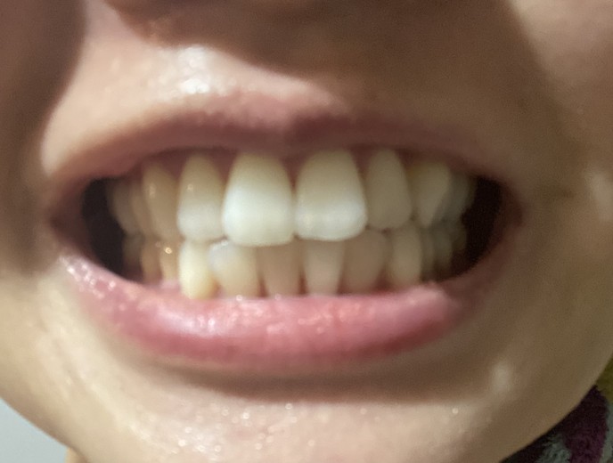 before photo: ホワイトニング