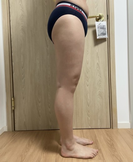 after photo: 허벅지지방흡입