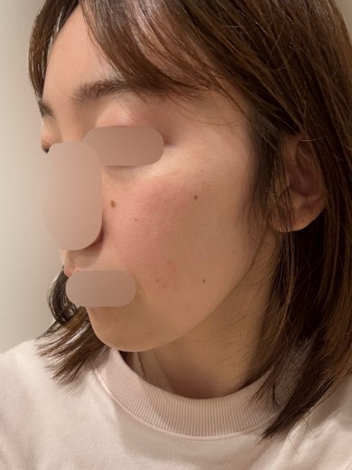 after photo: ルメッカ