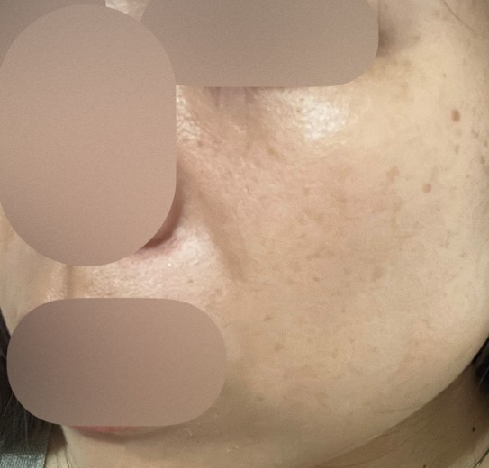 after photo: レーザートーニング, 診断・検査