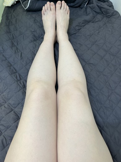 before photo: 脂肪溶解注射(太もも)