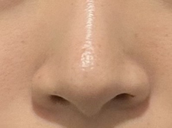 after photo: 콧볼축소