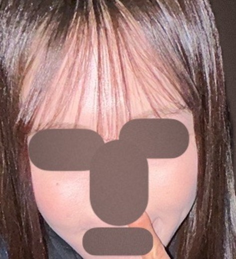 after photo: ララピール(LHAピーリング)