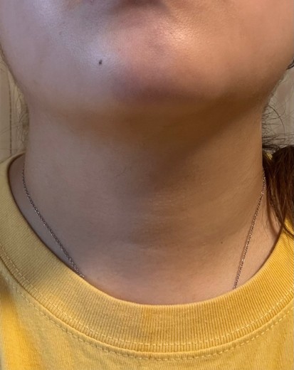 after photo: 脂肪溶解注射(顔)