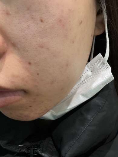 before photo: ダーマペン