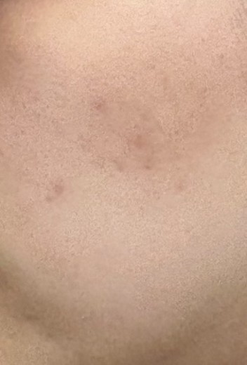 after photo: ピーリング, トラネキサム酸