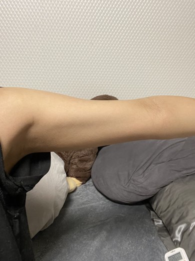 after photo: 脂肪吸引(腕)