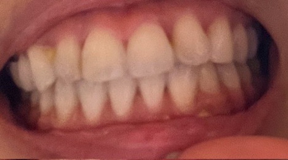 before photo: ホワイトニング