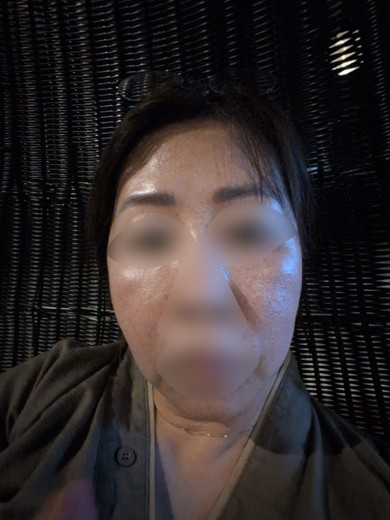 after photo: イオン導入