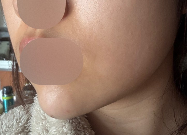 after photo: 턱끝필러