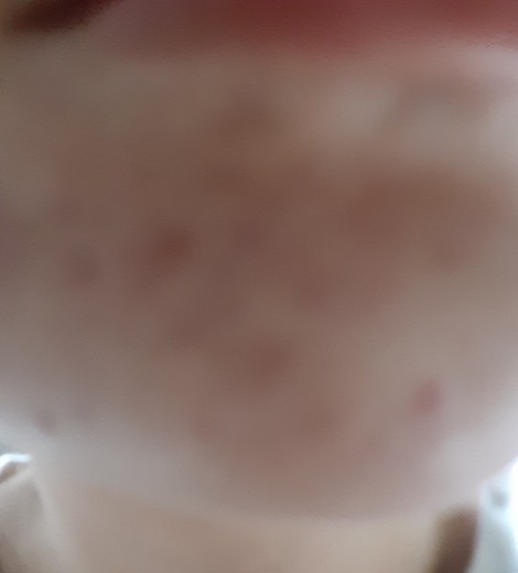 before photo: 여드름주사