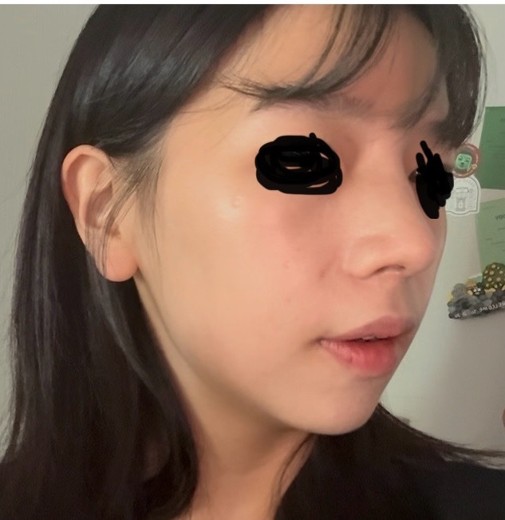 after photo: 비중격만곡증수술