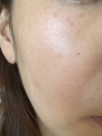 after photo: エレクトロポレーション