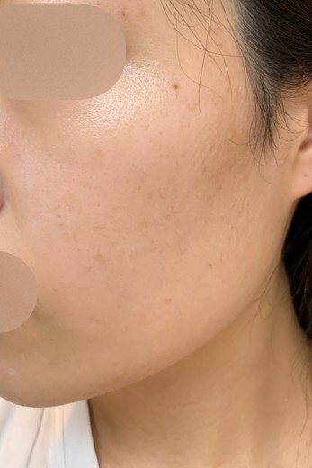 before photo: IPL(光/フォト治療), ルメッカ