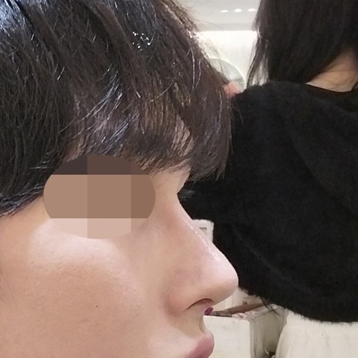 after photo: 콧대(자가조직), 코끝(자가연골)