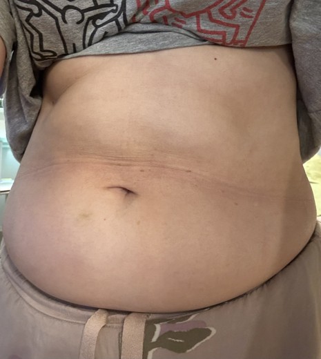 before photo: 脂肪冷却(腹部)