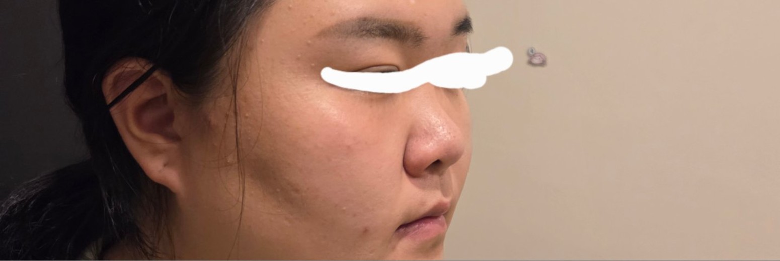 before photo: 비중격만곡증수술, 코끝(보형물)