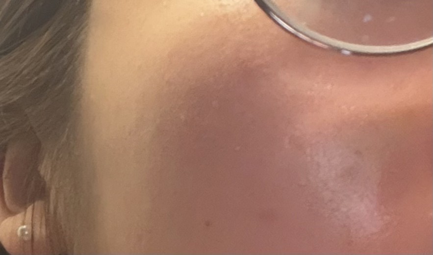 after photo: 윤곽주사, 사각턱보톡스