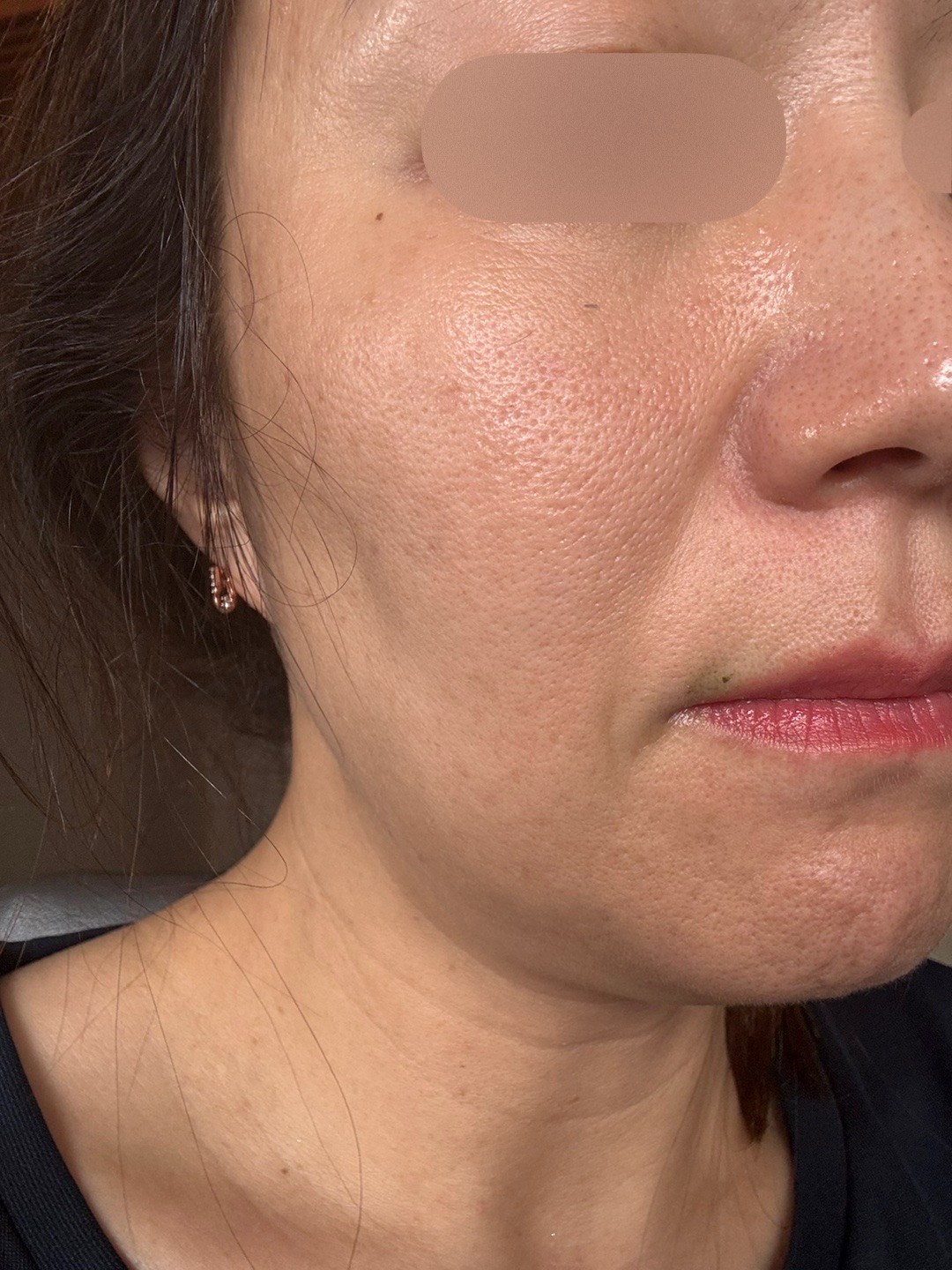 2023年最新エレクトロポレーション　ハイドラフェイシャル 2023年最新エレクトロポレーションハイドラフェイシャル