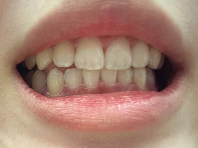 before photo: 치아미백