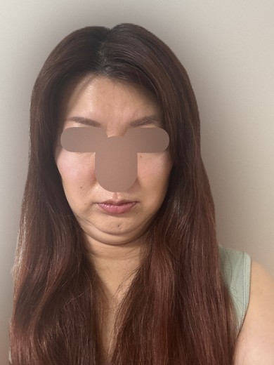 after photo: 脂肪溶解注射(顔)